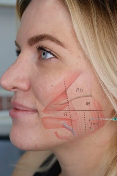 Masseter Botox: A Solution for Teeth Grinding and Jaw Tension