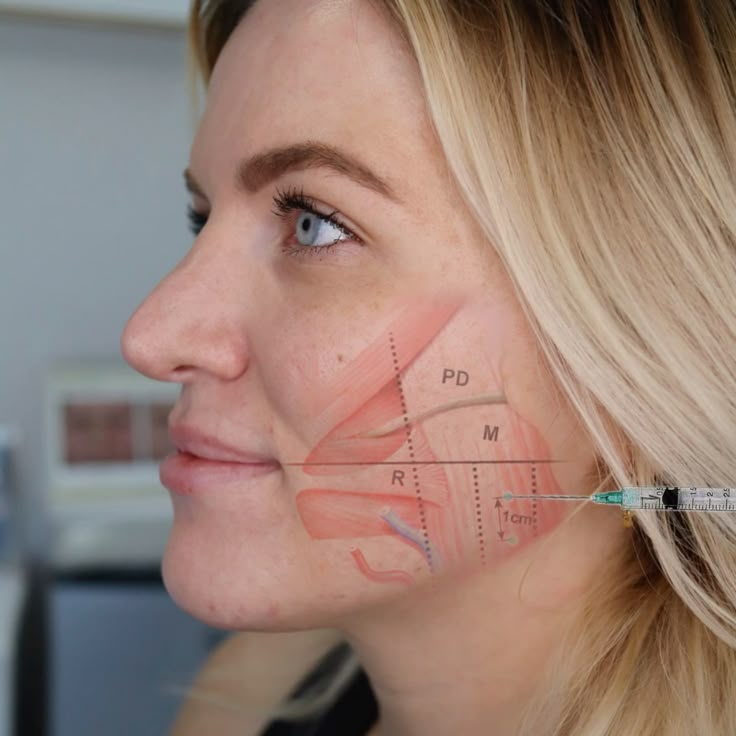 Masseter Botox: A Solution for Teeth Grinding and Jaw Tension